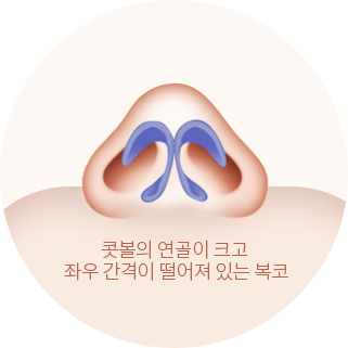 콧볼의 연골이 크고 좌우 간격이 떨어져 있는 복코