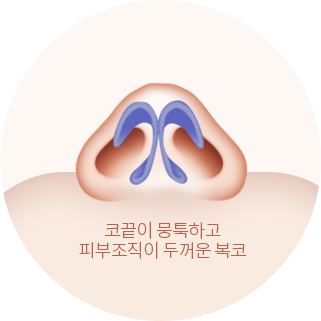 코끝이 뭉툭하고 피부조직이 두꺼운 복코